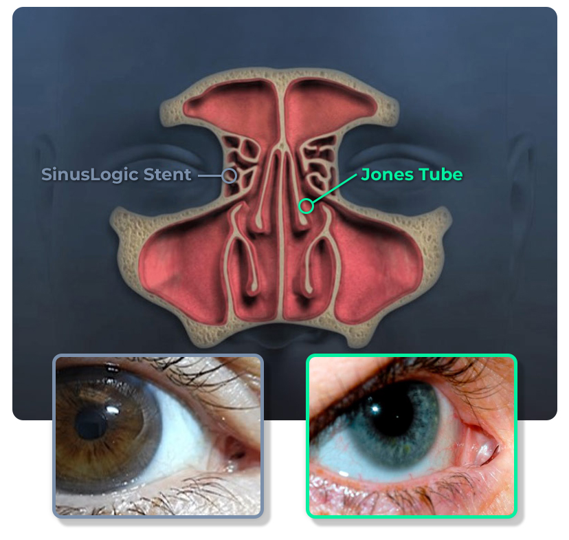 SinusLogic Sinus Anatomy and Stent Placement